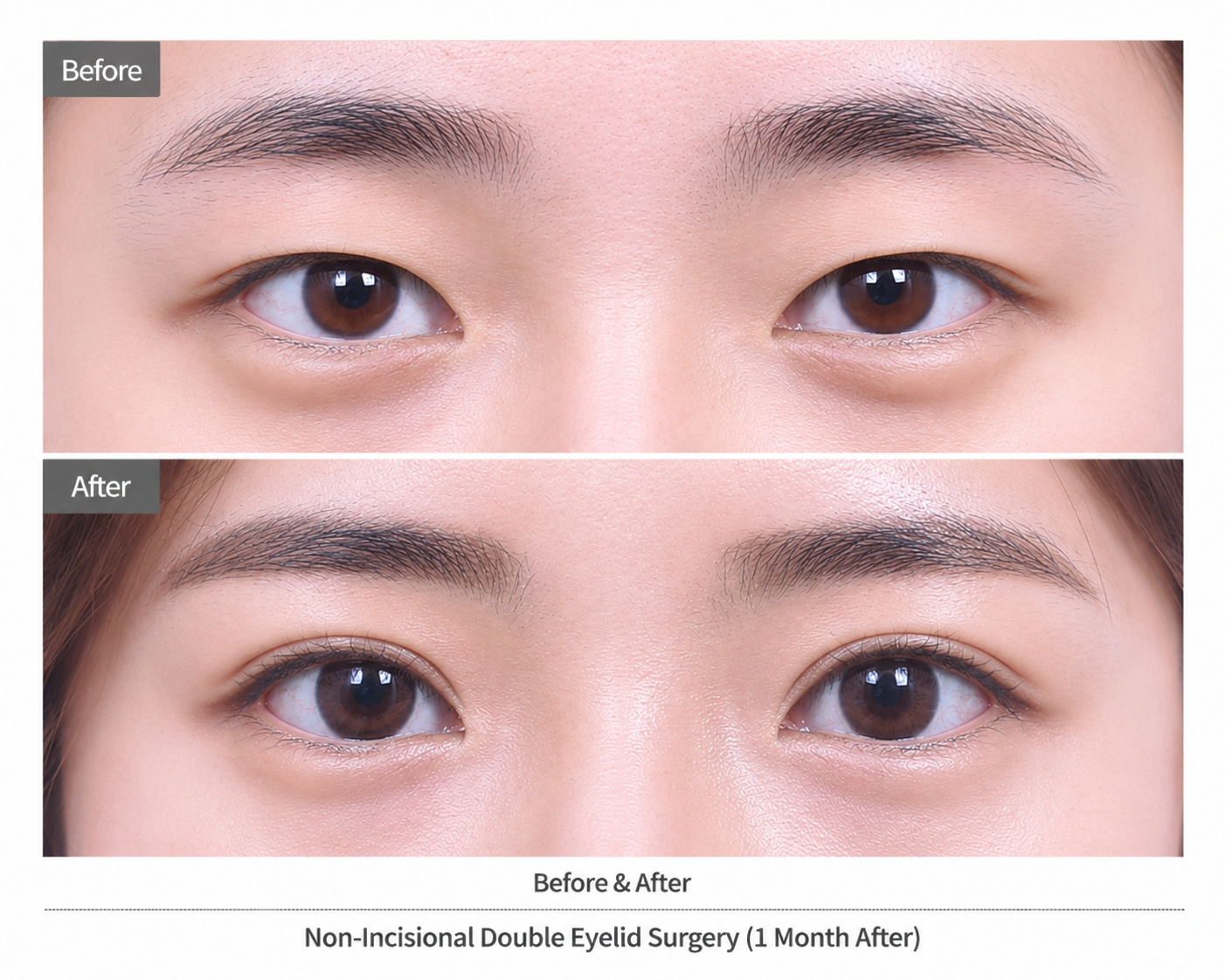 Korean double eyelid surgery