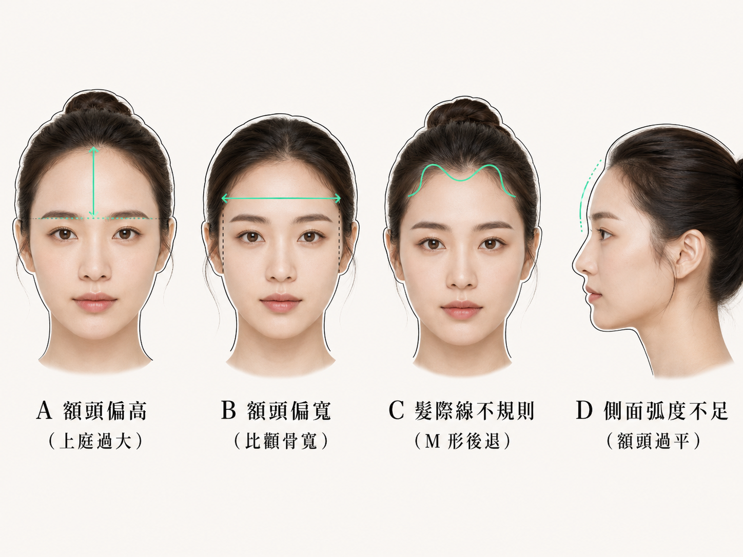 你的額頭是哪一種