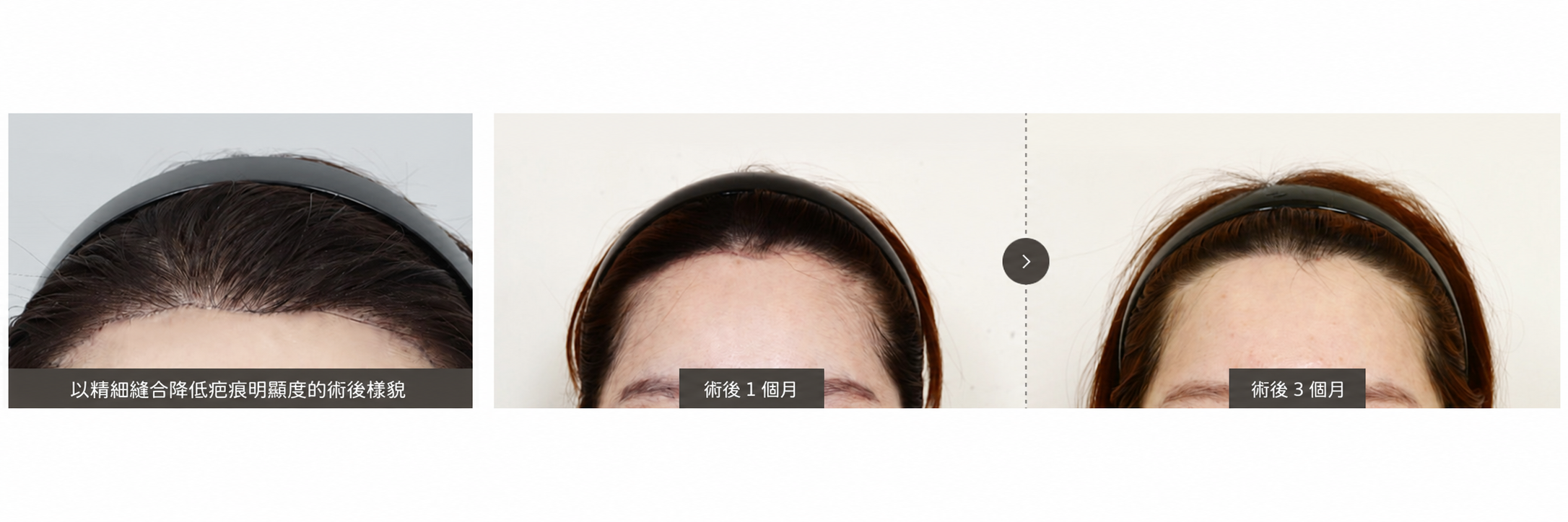 術後案例參考：縫合部位的時間變化