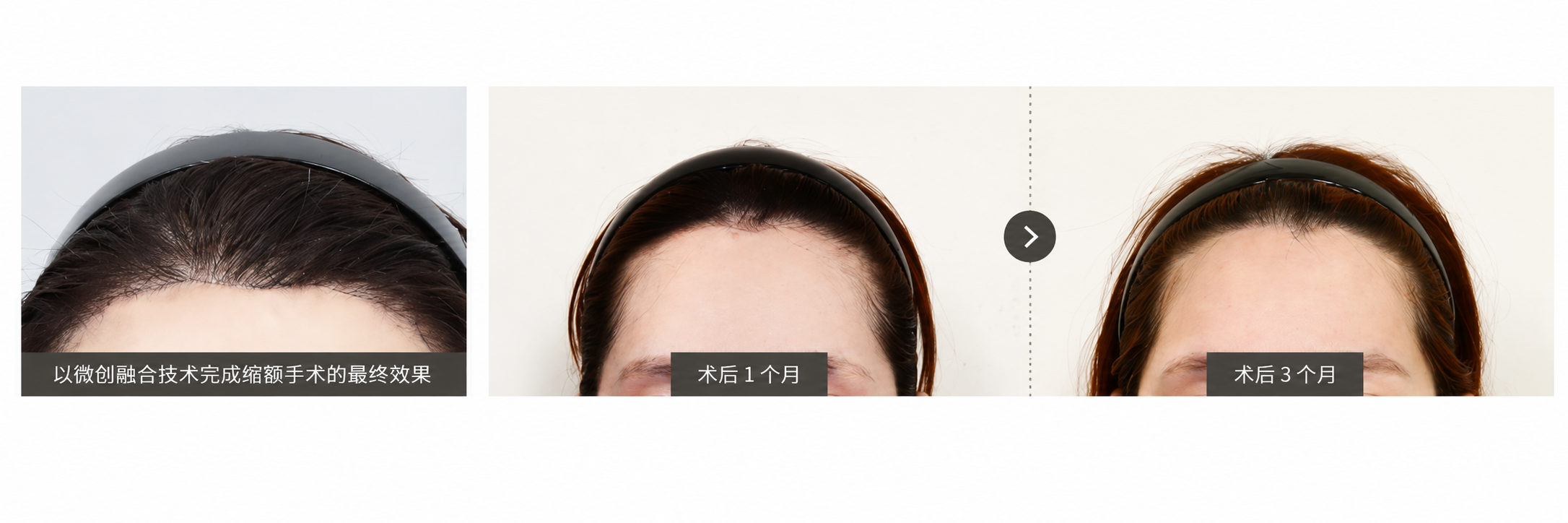 缝合部位的时间变化