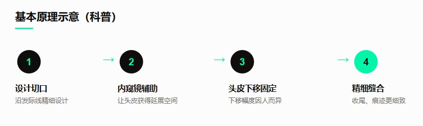 什么是额头缩小术？基本原理