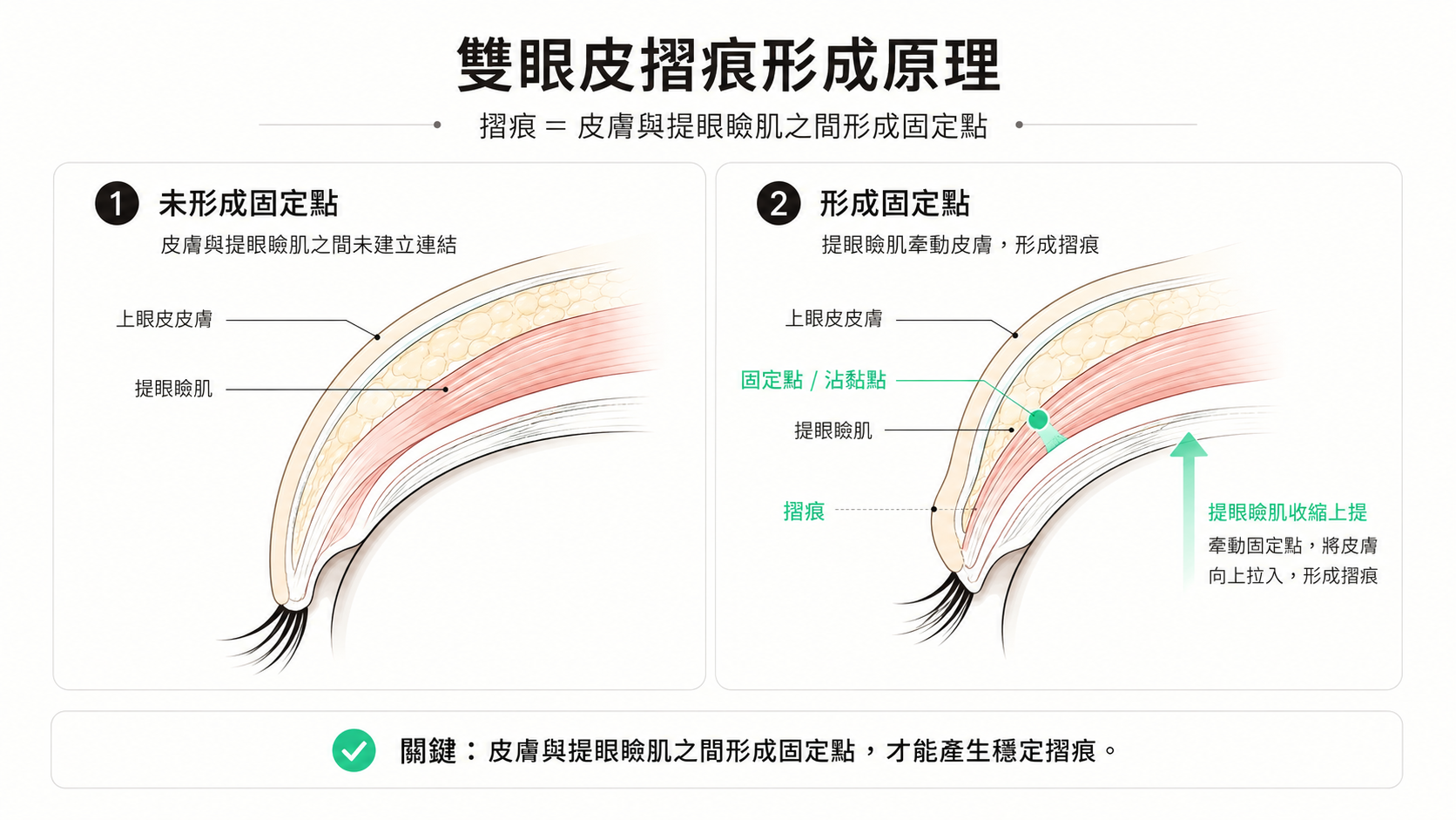 雙眼皮折痕原理