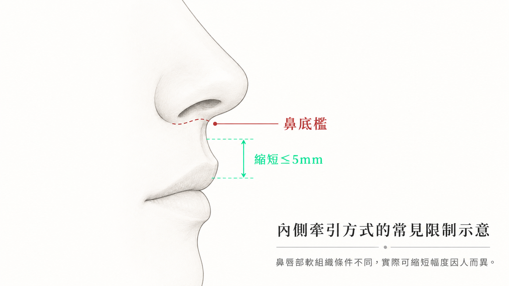 無痕/隱痕人中縮短