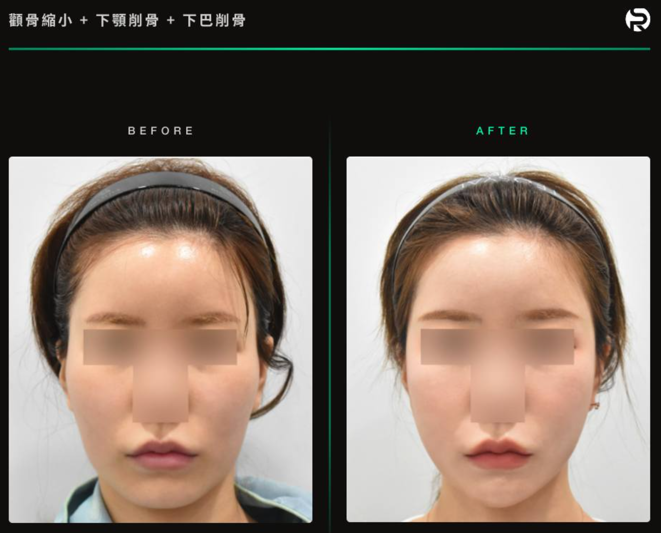 下顎削骨術後案例參考1