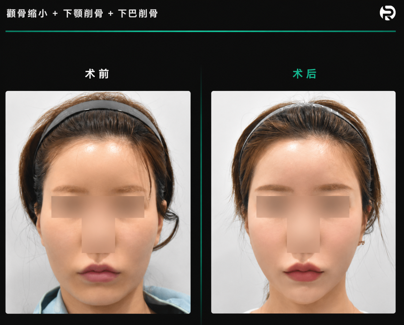 下颌角截骨术后案例1