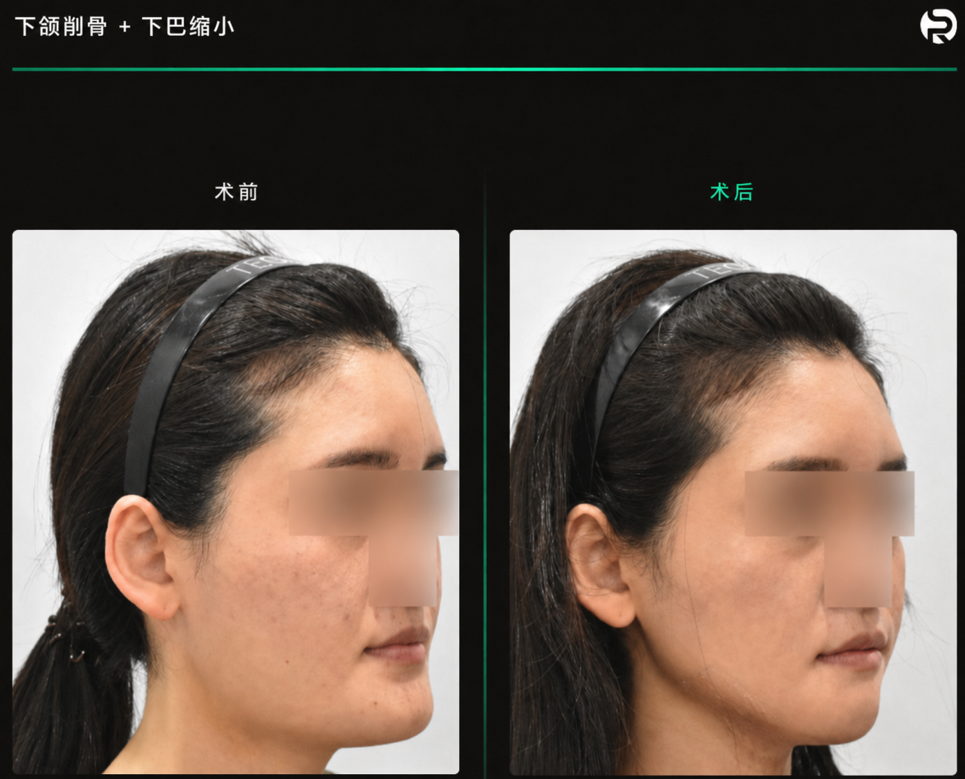 下颌角截骨术后案例参考