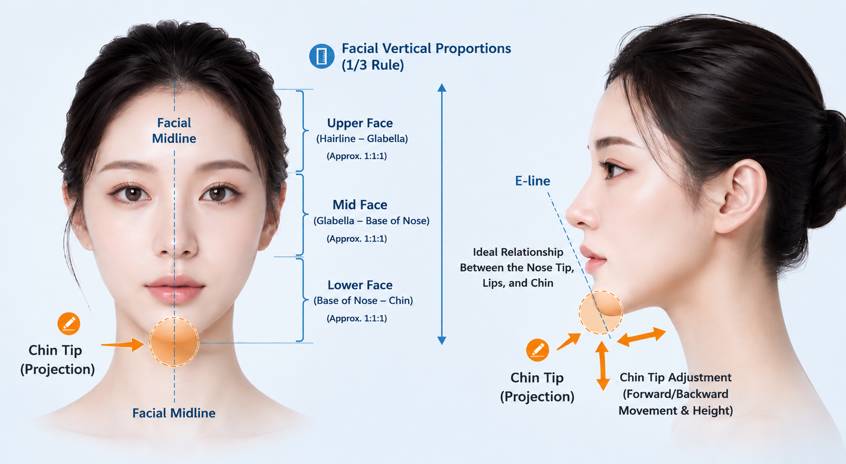 genioplasty-what-is