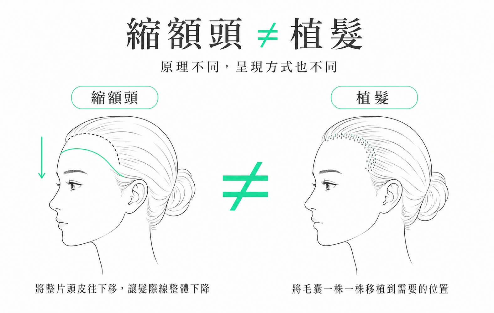 縮額頭 ≠ 植髮:兩種「降髮際線」的根本差別