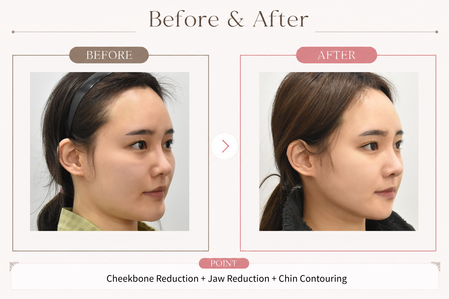Cheekbone reduction + jaw-angle reduction + genioplasty