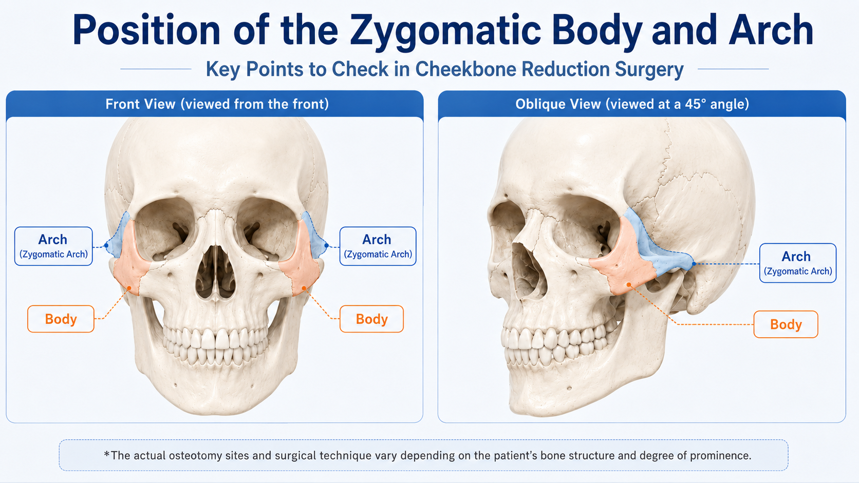 Diagram showing the zygomatic body and zygomatic arch in cheekbone reduction surgery, viewed from the front and at a 45-degree angle.