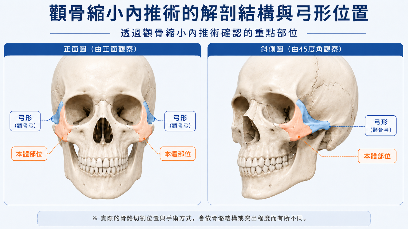 顴骨縮小內推術中顴骨本體與顴骨弓位置示意圖,包含正面與45度斜側面頭骨視角