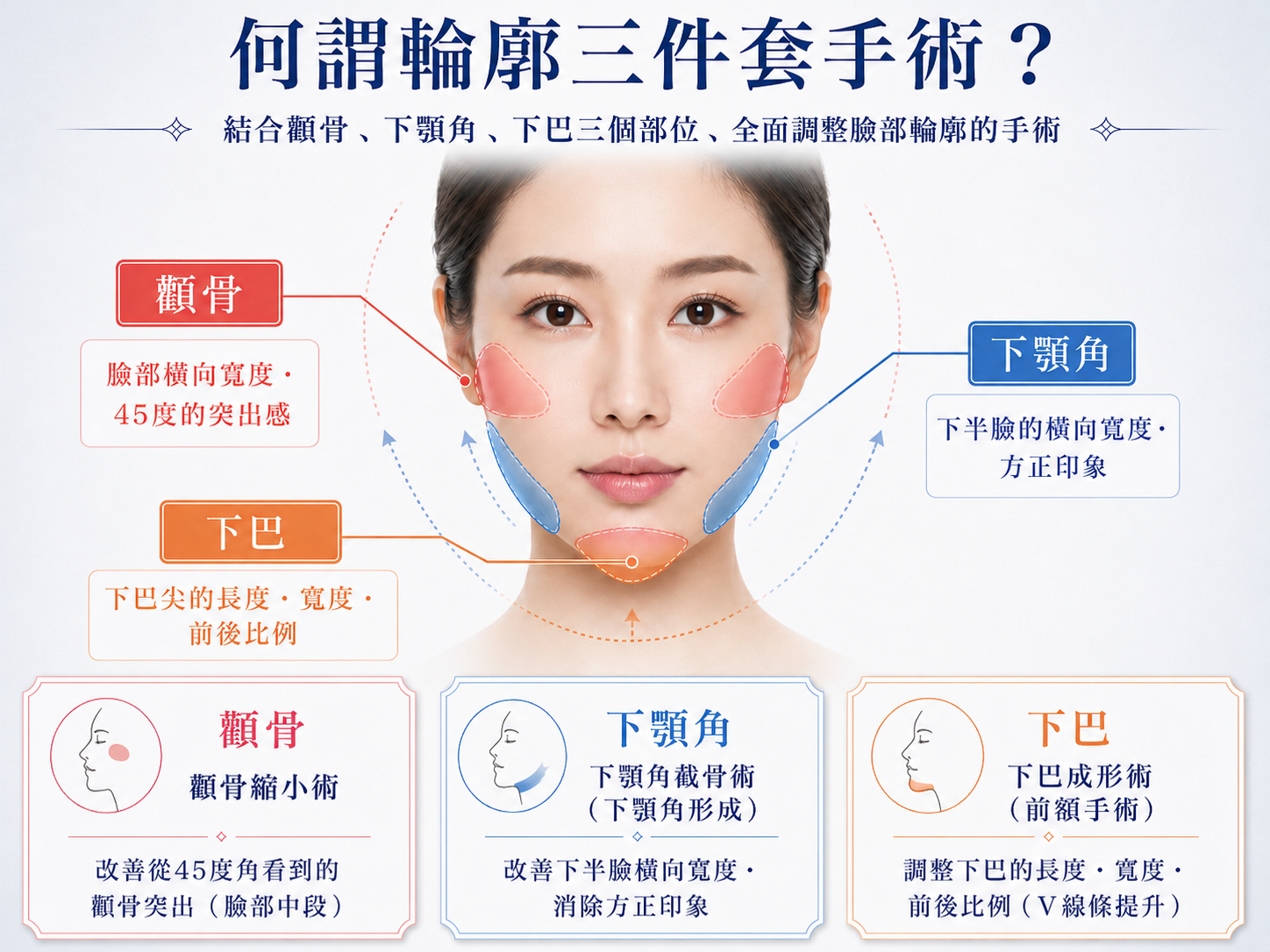 輪廓三件套手術示意圖,標示顴骨縮小術、下顎角截骨術與下巴成形術的改善部位及臉型調整效果