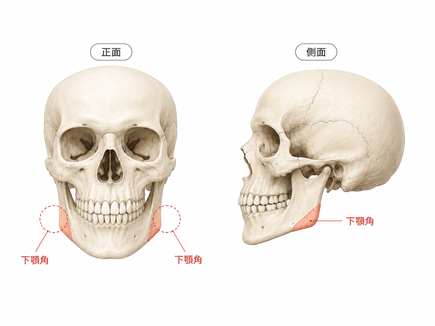 掲載用繁体字:標示削腮骨截骨部位——下顎角位置的解說圖