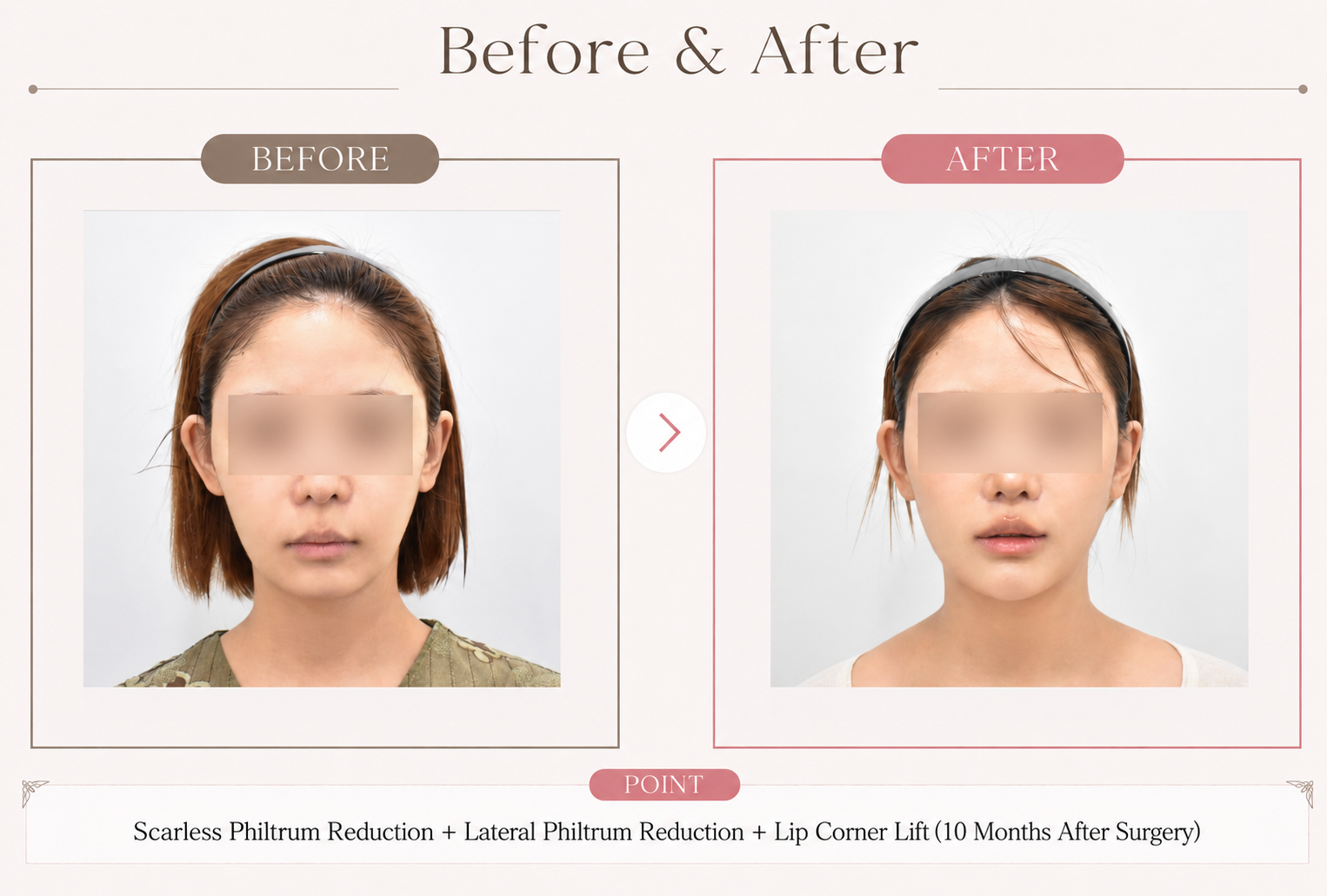 RESPEC Plastic Surgery case photo: scarless philtrum reduction + lateral philtrum reduction + corner lip lift (10 months post-op)