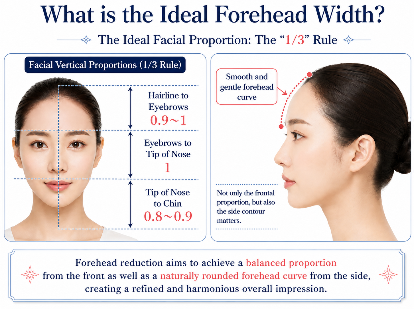 Diagram explaining the ideal forehead width and facial one-third proportions, including front and side views, forehead ratio measurements, and a naturally rounded forehead contour for forehead reduction surgery planning.