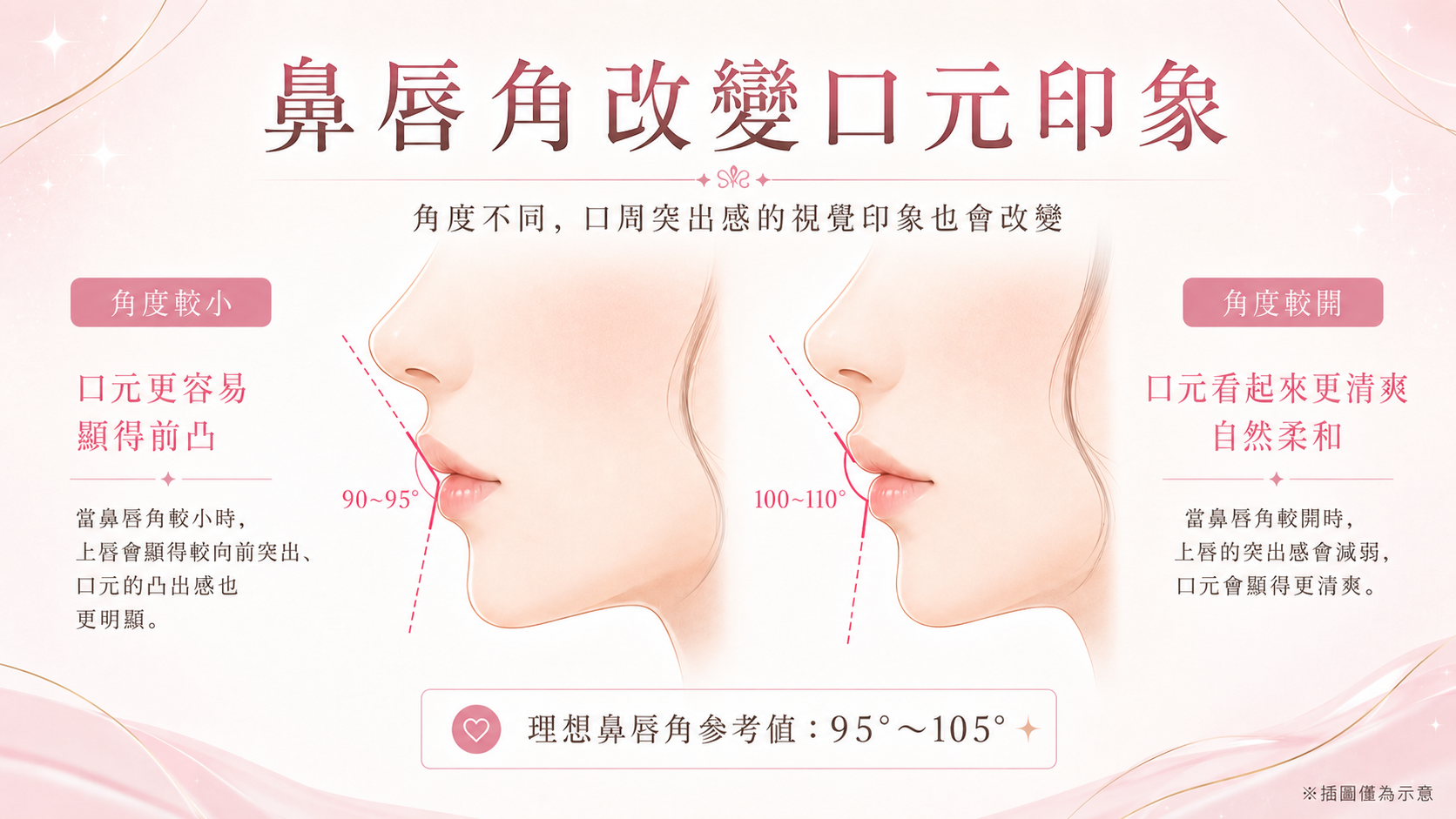 呈現鼻唇角角度差異如何影響嘴部凸出感的示意圖