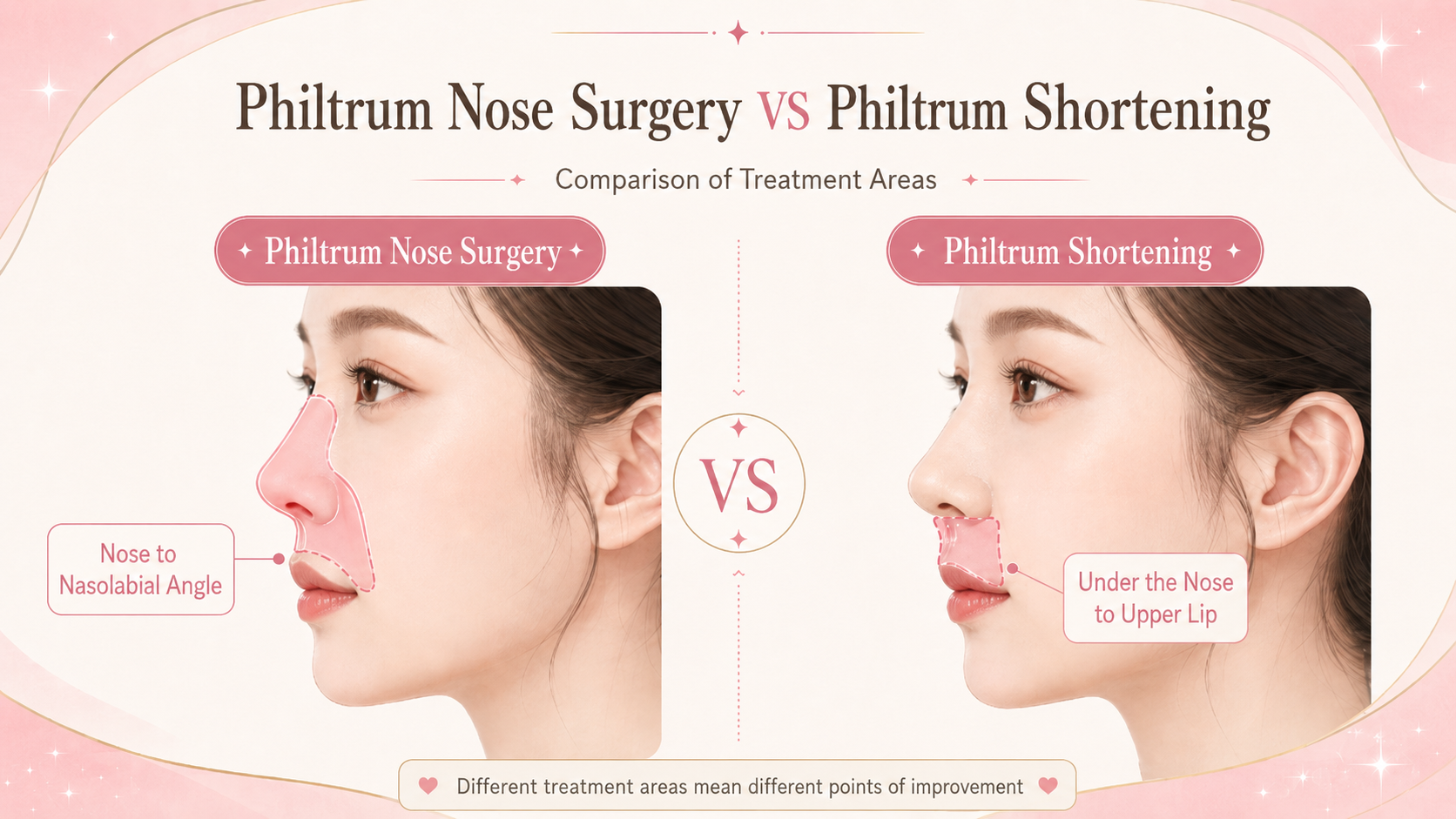 comparison of the areas treated by Philtrum-Nose surgery and a lip lift
