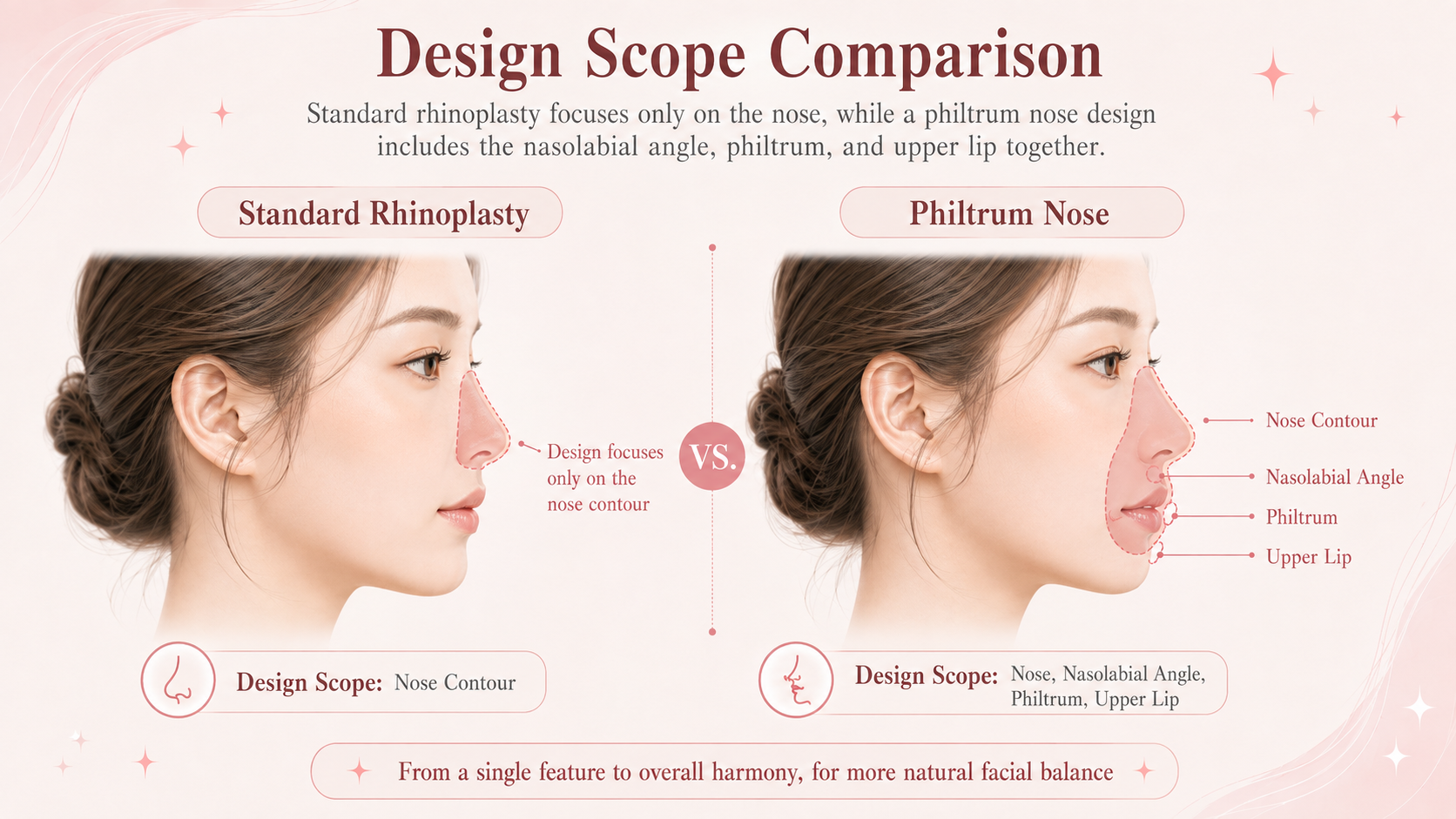 comparison of the design scope of standard rhinoplasty and Philtrum-Nose